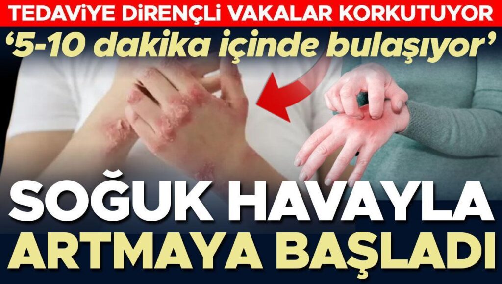 soguk havayla birlikte artmaya basladi tedaviye direncli vakalar korkuttu 5 10 dakikada bulasiyor KHhUlWyH