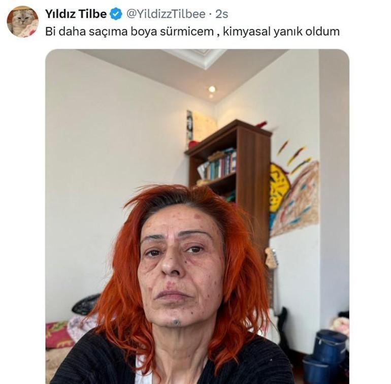 Yıldız Tilbe'nin yüzünde yanıklar oluştu... Görüntüsü korkuttu 1 yildiz tilbenin yuzunde yaniklar olustu goruntusu korkuttu 0 1V4SvncK