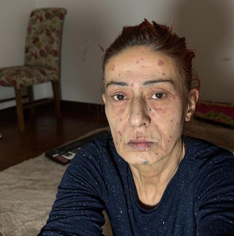 Yıldız Tilbe'nin yüzünde yanıklar oluştu... Görüntüsü korkuttu 2 yildiz tilbenin yuzunde yaniklar olustu goruntusu korkuttu 1 M1YhivzI