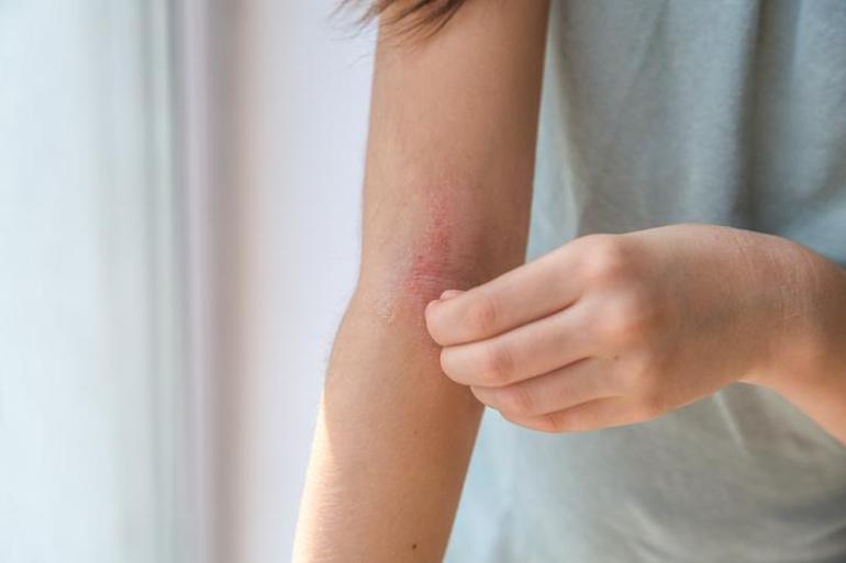 Aniden ortaya çıktı, artık suya dokunamıyor! “Bazen derimi kazımak istiyorum” 2 aniden ortaya cikti artik suya dokunamiyor bazen derimi kazimak istiyorum 1 5sJrL1Yu