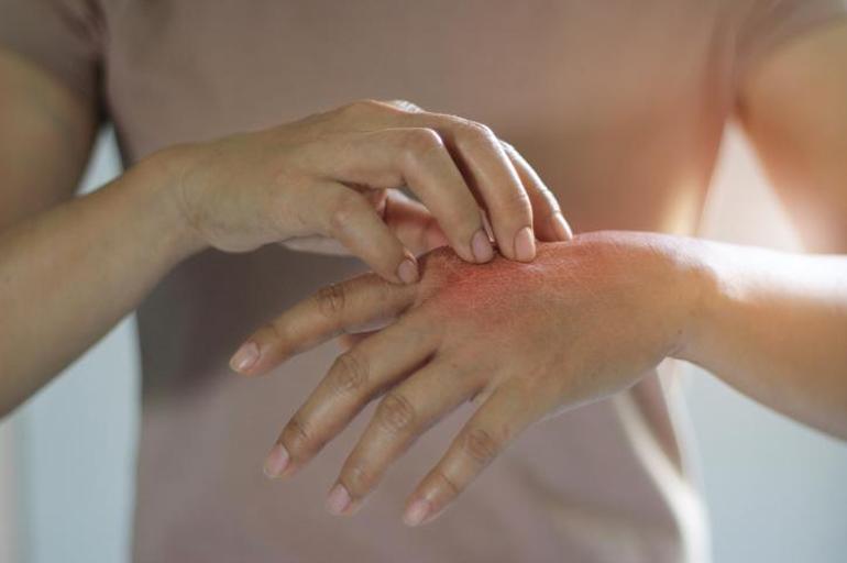 Aniden ortaya çıktı, artık suya dokunamıyor! “Bazen derimi kazımak istiyorum” 5 aniden ortaya cikti artik suya dokunamiyor bazen derimi kazimak istiyorum 4 sTFT9WrT