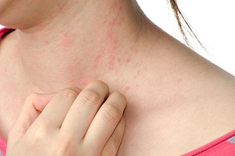 Aniden ortaya çıktı, artık suya dokunamıyor! “Bazen derimi kazımak istiyorum” 6 aniden ortaya cikti artik suya dokunamiyor bazen derimi kazimak istiyorum 5 3zbA4c3E