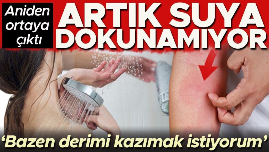 aniden ortaya cikti artik suya dokunamiyor bazen derimi kazimak istiyorum FX1JqJCF