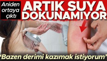 aniden ortaya cikti artik suya dokunamiyor bazen derimi kazimak istiyorum FX1JqJCF