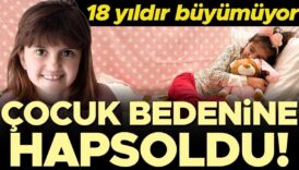 oyle bir hastalik ki genc kizi cocuk bedenine hapsetti 18 yildir neredeyse hic buyumuyor 7VpLep1c