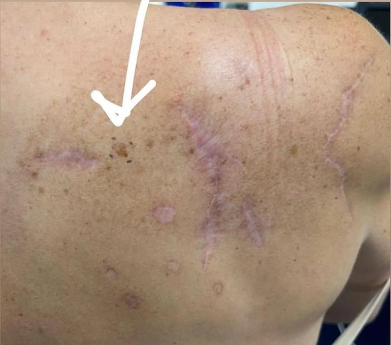 Ünlü oyuncunun bitmeyen kâbusu… Cilt kanserini yendim derken beyninde tümör bulundu! 4 unlu oyuncunun bitmeyen k busu cilt kanserini yendim derken beyninde tumor bulundu 3 WBjA5q9m